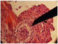 Figure 8. Testicular biopsy revealed few spermatids, along with spermatocytes