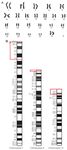 Figure 3. A) karyotype analysis of the mother, GTG-banded chromosomal analysis reveals the presence of a balanced translocation involving chromosome 2, 6, and 12; B) the exchanged segments were represented in ideogram
