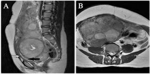 Figure 1. A) Sagittal T2 w image showing multiple fibroids in posterior wall of uterus and cervix with endometrial canal compressed anteriorly (black arrow), and anterior uterine wall (white arrow). B) Axial T2w image showing multiple fibroids in fundal region
