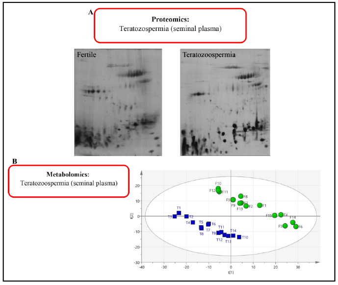 Figure 2. A: Comparison of the proteomics of seminal plasma in a fertile person and patient with teratozoospermia. B: The same metabolomics comparison. F: Fertile; T: Teratozoospermia
