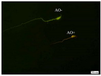 Figure 3. Spermatozoa with native double-stranded DNA (AO-) and denatured DNA (AO+); Acridine Orange staining (&times;100 eyepiece magnification)