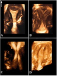 Figure 1. Three-dimentional sonography has become the gold standard tool for the diagnosis of congenital uterine anomalies; A: An arcuate uterus showing concave external uterine contour and smooth fundal indentation of the endometrial cavity. B: Incomplete septate uterus represents concave external contour with division of the uterine cavity (septum extending from the fundus to the lower part of uterine cavity). C: 3D image of a didelphic uterus illustrates duplication of endometrial cavities and cervical canals. D: 3D image of a unicornuate uterus shows a fusiform-shaped endometrial cavity