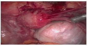 Figure 1. Primary laparoscopy feature of the tumor in a 24 year old patient, December 2012, Rasoul-e-Akram hospital, Tehran, Iran