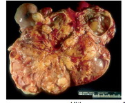 Figure 1. Gross photograph of malignant mixed germ tumor: The solid fleshy cut surface with few cysts along with areas of necrosis and haemorrhage