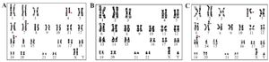 Figure 2. G-banded karyotype images of (A) Mother -45 XX, t (4;7) (q27;p22) rob (13;14) (q10;q10) (B) Father -46 XY Normal (C) Proband (child) -45 XY, t (4;7) (q27;p22) rob (13;14) (q10;q10)