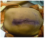 Figure 3. The abdominal wall after removal of skin stitches on the 7th post operative day