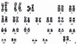 Figure 1. Karyotype showing 46, X, t(X;1)(q21,p32) chromosome constitution in a female with primary amenorrhea