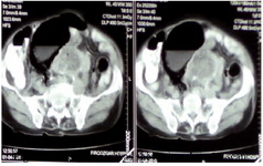 Figure 1.  Large mass was shown in pelvic CT scan