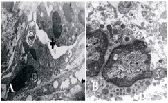 Figuer 6. Ultrastructural micrograph of seminiferous tubule in group of 25 μM/kg: myoepithelium (Arrow), necrotic spermatogonia (+), B: necrosis of spermatid. A: magnification 4400, B: magnification 7000