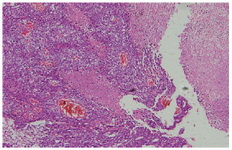 Figure 2. Pathology report, yolk sac tumor component of the ovarian germ cell tumor