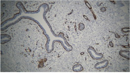 Figure 2. The small slit-like spaces in the stroma (pseudo-angiomatous spaces) are lined with cells that are stained with smooth muscle actin (SMA) marker in immunohistochemistry (IHC) study. Note that the basal cells around the mammary ducts are also stained with this marker, which is presumed as a normal histologic finding. Also, note that the benign proliferation and branching of breast ducts is closely similar to the benign fibroadenoma of the breast (X100; IHC staining for SMA marker)