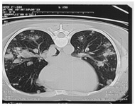 Figure 1. Pulmonary Metastasis in invasive mole
