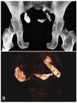 Figure 5. A: MIP and figure B: VRT image showing bilateral hydrosalpinx with minimal spill on right side
