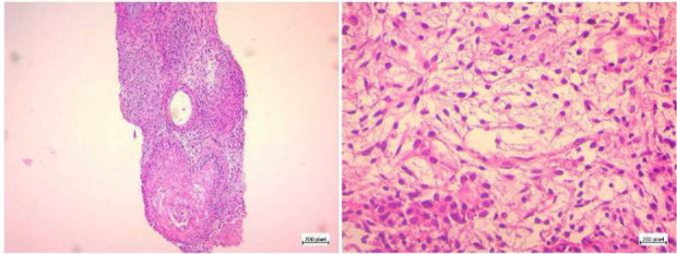Figure 1. Histologic examination before second-look surgery consistent with the diagnosis of immature teratoma