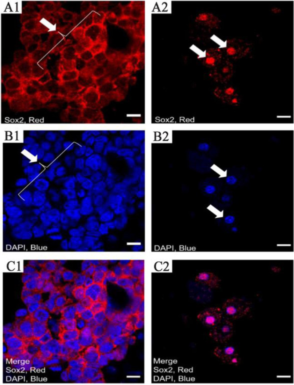 Figure 6. The pattern of Sox2 expression with immunocytochemistry in differentiated and undifferentiated cells of testis biopsy using confocal scanning UV-laser microscope. This Figure shows the expression of Sox2 in differentiated and undifferentiat