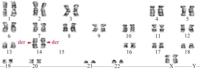 Figure 2. A karyotype image of fetal cells obtained through amniocentesis fluid revealed a chromosomal makeup of 44,XX,rob (14;15)×2
