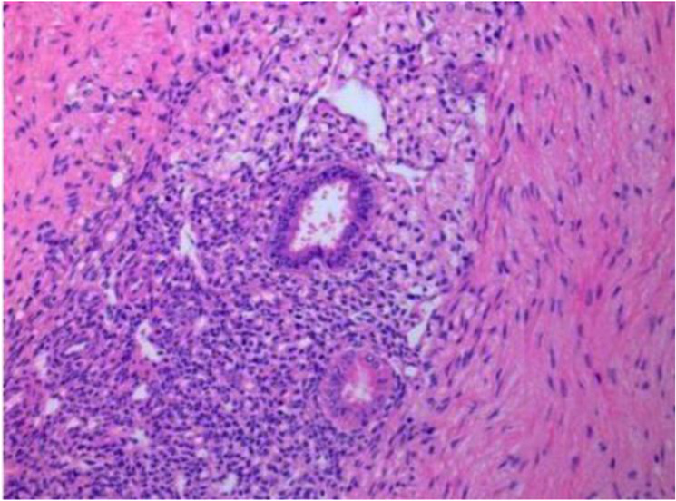 Figure 1 Pathological view of pelvic endometriosis lesions