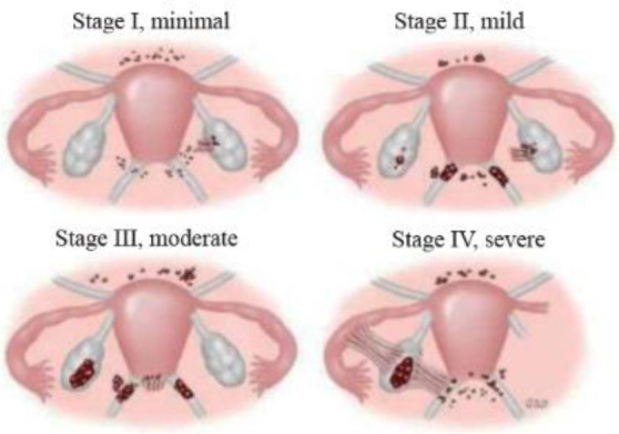 Figure 3 Criteria for revised classification of endometriosis by the American Society for Reproductive Medicine