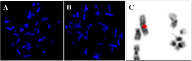 Figure 4 SE X (DXZ1-red)/SE Y (DYZ1-green); A) 45,X cell line with only one red signal for X chromosome; B) 46,X,idic(Yp) cell line with one red signal for X chromosome and no green signals for Yq12 heterochromatin region on the abnormal Y chromosome