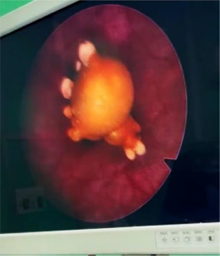 Figure 3. Cystoscopic view of the migrated intrauterine device (IUD)