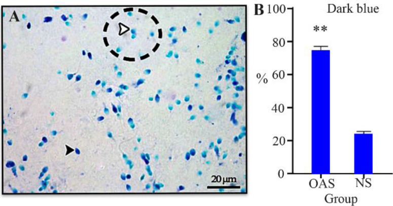 Figure 4. Toluidin Blue staining. A) Abnormal chromatin integrity were statined as dark blue, black arrow shows TB (+). Normal chromatins stained as light blus and white arrow shows TB (−). Bar: 20 μm. B) Chromatin integrity comparison between OAS an