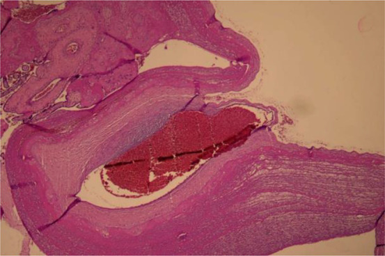 Figure 1. Histopathological examination showing massive subchorionic thrombosis in placenta