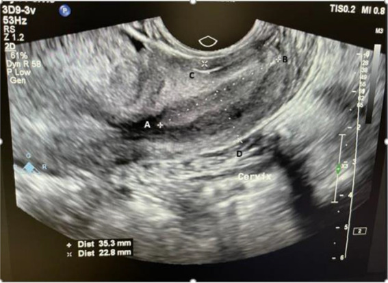 Figure 2. Longitudinal view (anteroposterior length: CD and cervical length: AB)