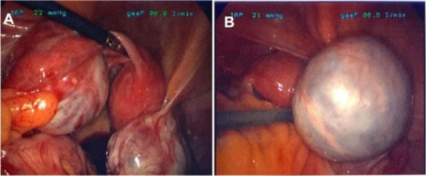 Figure 4 A laparoscopic view of bilateral ovarian cysts at second recurrence (A) with a 6 cm right benign mucinous cystadenoma (B)