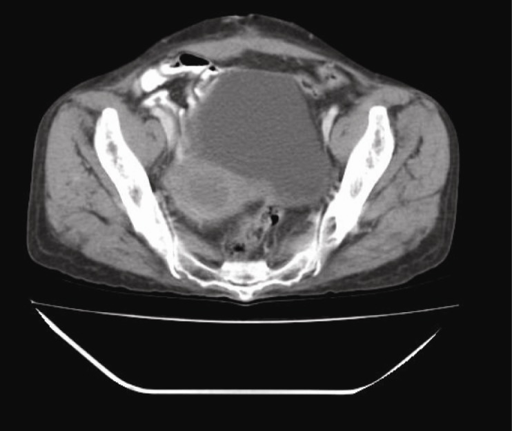 Figure 1 Post-operative contrast enhanced computerized tomography showing advanced carcinoma cervix