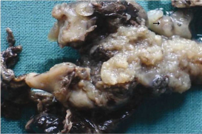 Figure 1 Ruptured tube showing fetus and placental tissue with molar changes