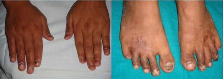 Figure 2 Shedding of hand and feet nails in 4 weeks