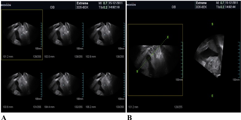 Figure 2 A and B: Multislice and three-dimensional ultrasound image (coronal view) in the 24th week of gestation showing the fenestration with a 17 mm diameter
