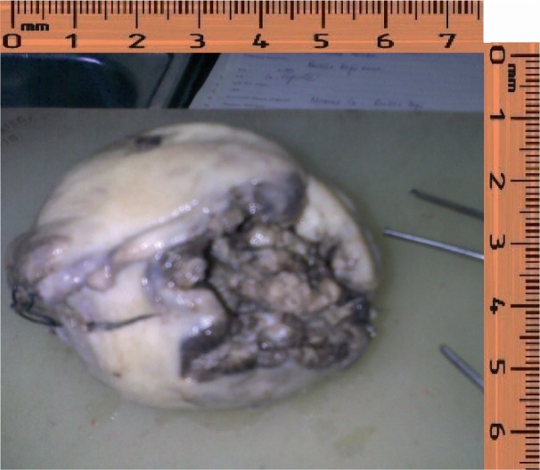 Figure 1 Post operative specimen of uterus showing large fundal defect