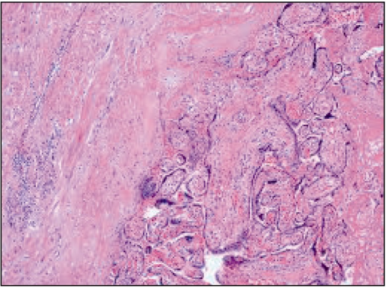Figure 2 Histopathological image of uterine tissue showing chorionic villi invading myometrium and absence of decidua basalis.