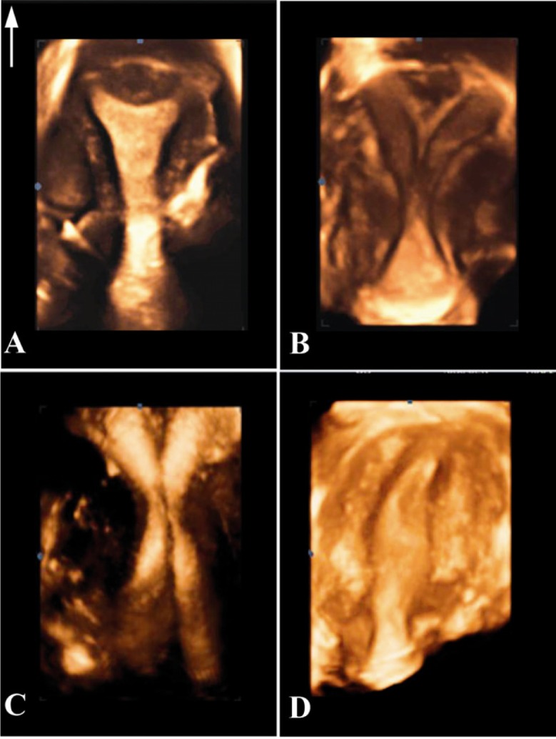 Figure 1 Three-dimentional sonography has become the gold standard tool for the diagnosis of congenital uterine anomalies; A: An arcuate uterus showing concave external uterine contour and smooth fundal indentation of the endometrial cavity. B: Incom