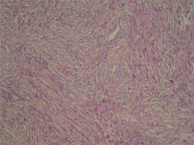 Figure 2 Pathologic feature of the tumor in a 24 year old patient, December 2012, Rasoul-e-Akram hospital, Tehran, Iran