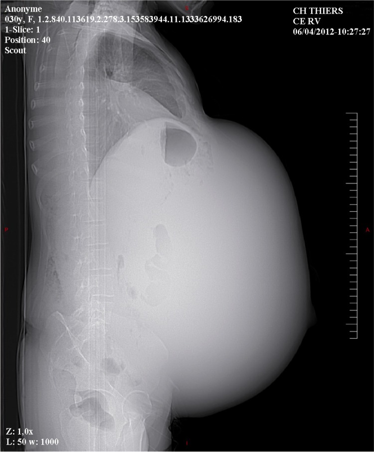 Figure 2 Scout view of the abdominopelvic mass