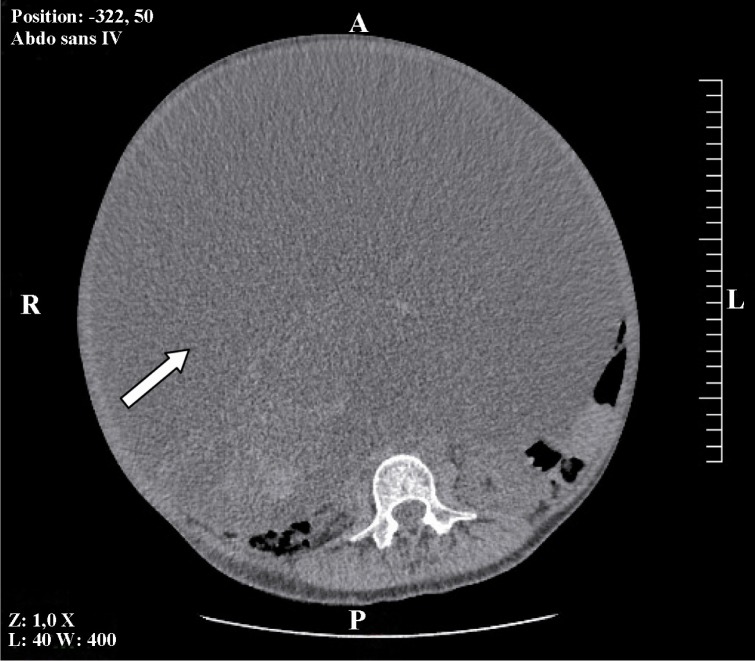Figure 4 Abdominal axial CT-scan showing a voluminous ovarian cyst (white arrow)