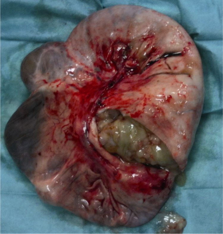 Figure 6 Macroscopic view of the ovarian tumor