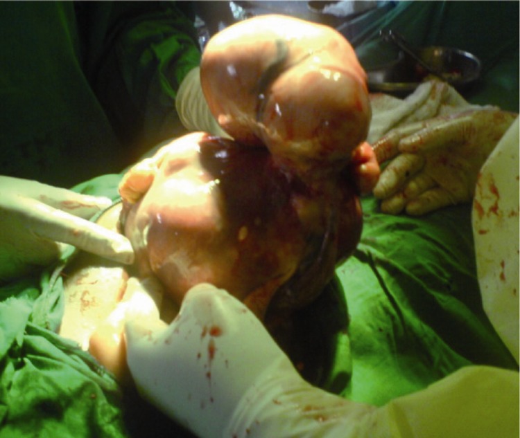 Figure 2 Intra-operative picture of the uterus delivered through the incision site before the removal of the fibroid masses