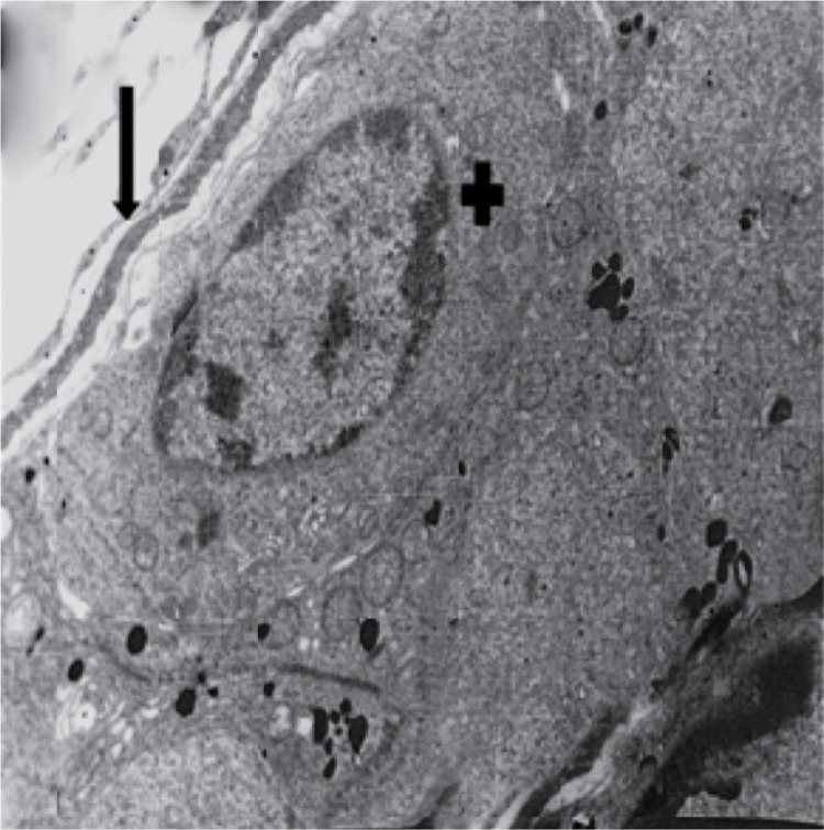 Figure 5 Ultrastructural micrograph of seminiferous tubule in group of 15 μM/kg: myoepithelial (Arrow), spermatogonia with apoptotic nucleus (+). Magnification 4400