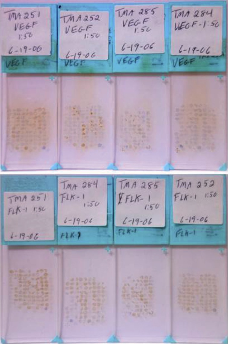Figure 1 Examples of tissue microarray slides immunostained with VEGF and Flk-1 antibodies