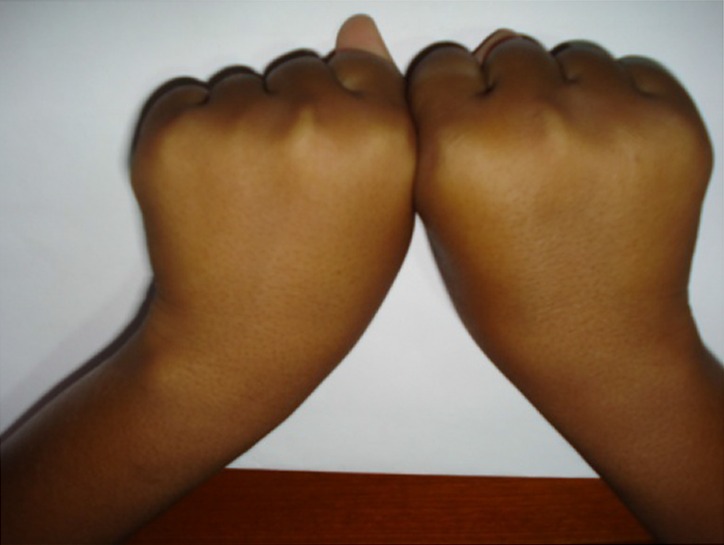 Figure 1. Depressed 4th and 5th finger knuckles in the clenching fist position