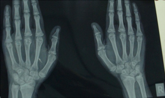 Figure 2. Shortening of metacarpals IV and V