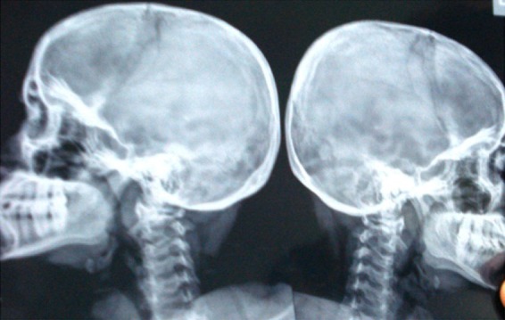 Figure 3. X Ray of the skull showing normal pituitary fossa
