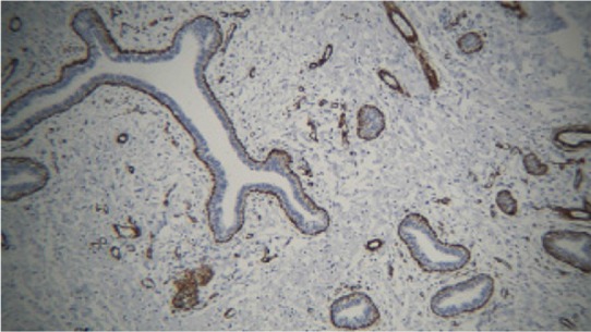 Figure 2. The small slit-like spaces in the stroma (pseudo-angiomatous spaces) are lined with cells that are stained with smooth muscle actin (SMA) marker in immunohistochemistry (IHC) study. Note that the basal cells around the mammary ducts are als
