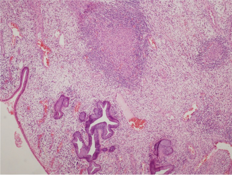 Figure 1. H&E, 4X-Section showing endocervical epithelium with epitheloid granuloma in the stroma
