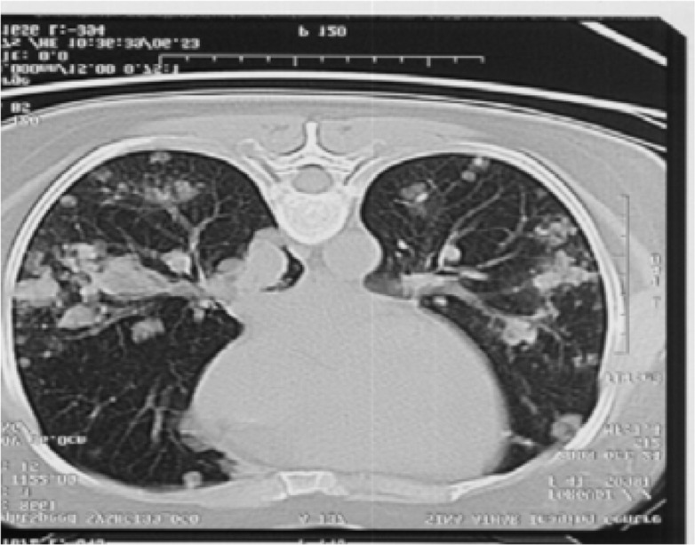 Figure 1. Pulmonary Metastasis in invasive mole