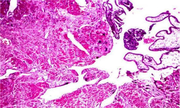 Figure 3. Villous formation in myometrium