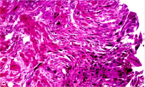 Figure 4. Villosity with necrosis in invasive mole